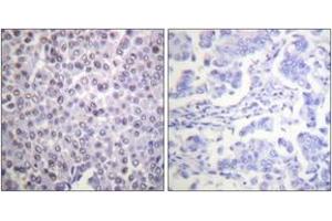 Immunohistochemistry analysis of paraffin-embedded human breast carcinoma tissue, using Histone H4 (Ab-12) Antibody. (Histone H4 antibody  (AA 10-59))