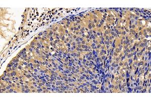 Detection of BLK in Human Breast cancer Tissue using Polyclonal Antibody to B-Lymphoid Tyrosine Kinase (BLK) (BLK antibody  (AA 241-494))