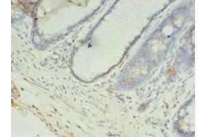 Immunohistochemistry of paraffin-embedded human colon cancer using ABIN7148128 at dilution of 1:100 (CCDC57 antibody  (AA 1-300))