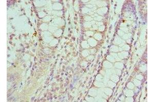 Immunohistochemistry of paraffin-embedded human colon cancer using ABIN7170857 at dilution of 1:100 (SMC1A antibody  (AA 1-130))