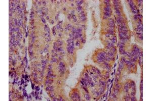 IHC image of ABIN7127694 diluted at 1:100 and staining in paraffin-embedded human endometrial cancer performed on a Leica BondTM system. (Recombinant FOXO3 antibody  (pSer253))