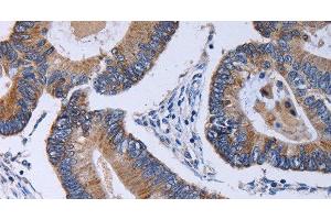 Immunohistochemistry of paraffin-embedded Human colon cancer using CA4 Polyclonal Antibody at dilution of 1:30 (CA4 antibody)
