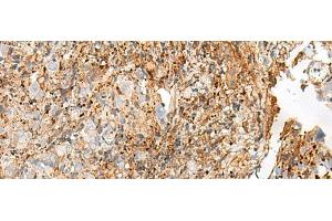 Immunohistochemistry of paraffin-embedded Human cervical cancer tissue using GPR27 Polyclonal Antibody at dilution of 1:25(x200) (GPR27 antibody)
