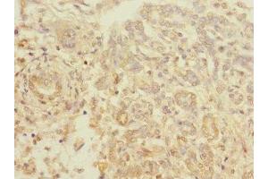 Immunohistochemistry of paraffin-embedded human pancreatic cancer using ABIN7172196 at dilution of 1:100 (TIGD7 antibody  (AA 1-300))