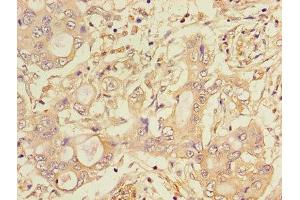 Immunohistochemistry of paraffin-embedded human pancreatic cancer using ABIN7158780 at dilution of 1:100 (CTSA antibody  (AA 30-327))