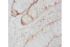 Immunohistochemistry of paraffin-embedded human colon cancer using ABIN7146964 at dilution of 1:20 (Caspase 8 antibody  (AA 217-374))