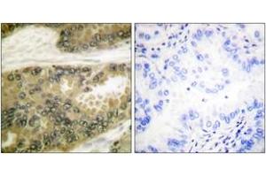 Immunohistochemistry analysis of paraffin-embedded human lung carcinoma tissue, using Cyclin D3 (Ab-283) Antibody. (Cyclin D3 antibody  (AA 243-292))