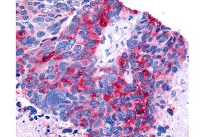 Anti-RORB / ROR Beta antibody IHC of human Lung, Small Cell Carcinoma. (RORB antibody  (Ligand Binding Domain))