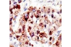 IHC analysis of FFPE human hepatocarcinoma stained with the Ubiquitin antibody (Ubiquitin antibody  (AA 36-66))