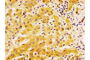 IHC image of ABIN7173899 diluted at 1:500 and staining in paraffin-embedded human liver cancer performed on a Leica BondTM system. (EDAR antibody  (AA 27-170))