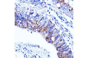 Immunohistochemistry of paraffin-embedded human colon carcinoma using PALLD Rabbit pAb  at dilution of 1:100 (40x lens). (PALLD antibody  (AA 383-672))