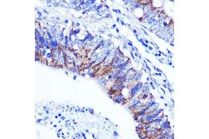 Immunohistochemistry of paraffin-embedded human colon carcinoma using PALLD Rabbit pAb  at dilution of 1:100 (40x lens). (PALLD antibody  (AA 383-672))