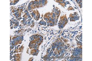 Immunohistochemistry of Human colon cancer using NPPA Polyclonal Antibody at dilution of 1:60 (NPPA antibody)