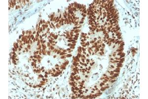Formalin-fixed, paraffin-embedded human Colon Carcinoma stained with MSH6 Mouse Monoclonal Antibody (MSH6/3091). (MSH6 antibody  (AA 374-540))