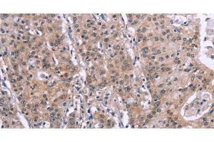 Immunohistochemistry of paraffin-embedded Human gastric cancer tissue using GPR172B Polyclonal Antibody at dilution 1:40 (GPR172B antibody)