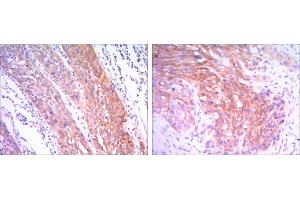 Immunohistochemical analysis of paraffin-embedded esophagus cancer tissues (left) and human lung cancer (right) using HK2 antibody with DAB staining. (Hexokinase 2 antibody)