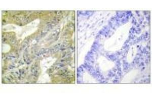 Immunohistochemistry analysis of paraffin-embedded human colon carcinoma tissue using HEXB antibody.