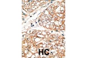 Formalin-fixed and paraffin-embedded human cancer tissue reacted with the primary antibody, which was peroxidase-conjugated to the secondary antibody, followed by DAB staining. (BOK antibody  (AA 60-90))