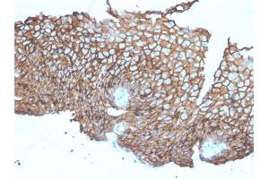 Formalin-fixed, paraffin-embedded human Esophageal Carcinoma stained with Desmoglein-3 Mouse Monoclonal Antibody (DSG3/2840). (Desmoglein 3 antibody  (AA 379-491))