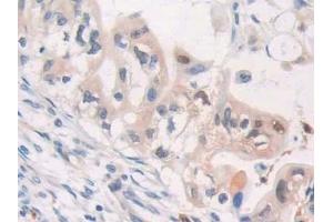 Detection of CDA in Human Bile duct cancer Tissue using Polyclonal Antibody to Cytidine Deaminase (CDA)