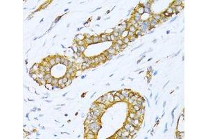 Immunohistochemistry of paraffin-embedded Human breast cancer using VARS Polyclonal Antibody at dilution of 1:100 (40x lens). (VARS antibody)
