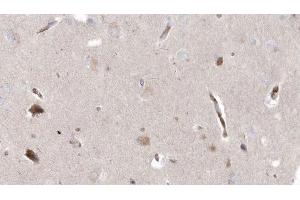 ABIN6272964 at 1/100 staining Human brain cancer tissue by IHC-P. (MPV17 antibody  (Internal Region))