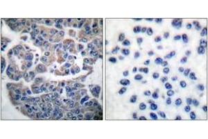 Immunohistochemistry analysis of paraffin-embedded human breast carcinoma, using eEF2K (Phospho-Ser366) Antibody. (EEF2K antibody  (pSer366))