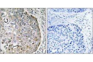Immunohistochemistry analysis of paraffin-embedded human lung carcinoma tissue, using MRRF Antibody. (MRRF antibody  (AA 181-230))