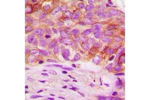 Immunohistochemical analysis of Ezrin (pT567) staining in human breast cancer formalin fixed paraffin embedded tissue section. (Ezrin antibody  (C-Term, pSer567))