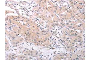 The image on the left is immunohistochemistry of paraffin-embedded Human lung cancer tissue using ABIN7131156(SPATA16 Antibody) at dilution 1/25, on the right is treated with fusion protein. (SPATA16 antibody)