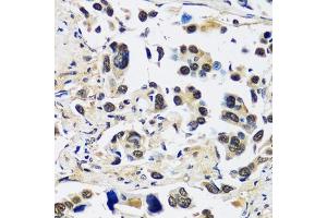Immunohistochemistry of paraffin-embedded human lung cancer using CCDC59 antibody (ABIN7266440) at dilution of 1:100 (40x lens). (CCDC59 antibody  (AA 1-241))