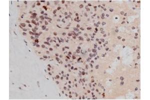ABIN6267361 at 1/200 staining Human liver cancer tissue sections by IHC-P. (MAPT antibody  (pThr181))