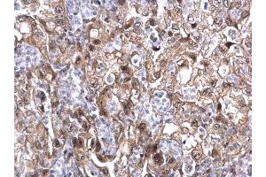 IHC-P Image MAF1 antibody detects MAF1 protein at nucleus on human endometrial carcinoma by immunohistochemical analysis. (MAF1 antibody  (Center))