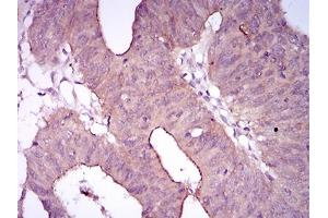 Immunohistochemical analysis of paraffin-embedded rectum cancer tissues using EGFR mutant mouse mAb with DAB staining. (EGFR antibody  (Mutant))