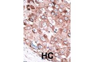 Formalin-fixed and paraffin-embedded human cancer tissue reacted with the primary antibody, which was peroxidase-conjugated to the secondary antibody, followed by AEC staining. (BAK1 antibody  (AA 56-91))