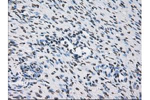Immunohistochemical staining of paraffin-embedded Adenocarcinoma of breast tissue using anti-ID3 mouse monoclonal antibody. (ID3 antibody)