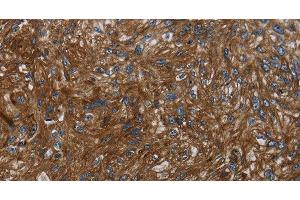 Immunohistochemistry of paraffin-embedded Human esophagus cancer tissue using KISS1R Polyclonal Antibody at dilution 1:30 (KISS1R antibody)