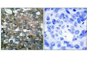 Immunohistochemical analysis of paraffin-embedded human breast carcinoma tissue using (EGFR antibody)