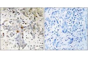 Immunohistochemistry analysis of paraffin-embedded human breast carcinoma tissue, using ZCCHC17 Antibody.