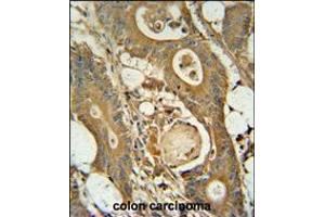 GCNT3 antibody immunohistochemistry analysis in formalin fixed and paraffin embedded human colon carcinoma followed by peroxidase conjugation of the secondary antibody and DAB staining. (GCNT3 antibody  (C-Term))