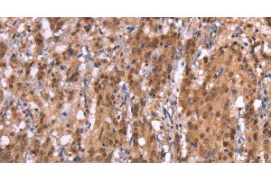 Immunohistochemistry of paraffin-embedded Human gasrtic cancer tissue using AMER1 Polyclonal Antibody at dilution 1:40 (WTX antibody)