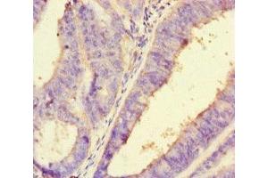 Immunohistochemistry of paraffin-embedded human endometrial cancer using ABIN7162730 at dilution of 1:100 (PDLIM5 antibody  (AA 268-404))