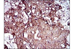 Immunohistochemical analysis of paraffin-embedded esophageal cancer tissues using DSG3 mouse mAb with DAB staining.