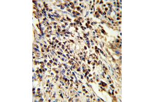 Formalin-fixed and paraffin-embedded human lung carcinoma reacted with PS Antibody (Center), which was peroxidase-conjugated to the secondary antibody, followed by DAB staining.