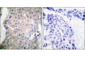 Immunohistochemistry analysis of paraffin-embedded human breast carcinoma tissue, using CPI17 alpha (Ab-38) Antibody. (CPI-17 antibody  (AA 5-54))