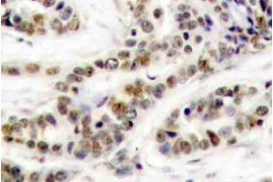 Immunohistochemistry (IHC) analyzes of p-CREB-1 antibody in paraffin-embedded human breast carcinoma tissue. (CREB1 antibody  (pSer129))
