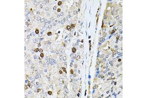 Immunohistochemistry of paraffin-embedded human prostate cancer using PNKP antibody (ABIN5974039) at dilution of 1/100 (40x lens).