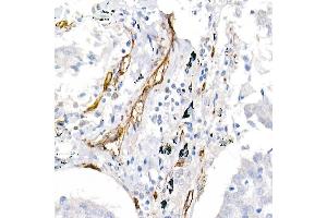 Immunohistochemistry of paraffin-embedded human lung cancer using CD146/MCAM Rabbit pAb (ABIN6127568, ABIN6143621, ABIN6143622 and ABIN6218100) at dilution of 1:25 (40x lens). (MCAM antibody  (AA 447-646))