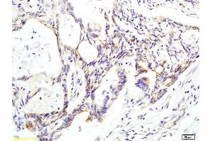 Formalin-fixed and paraffin embedded human colon carcinoma labeled with Anti phospho-CK II beta (Ser209) Polyclonal Antibody, Unconjugated (ABIN872284) at 1:200 followed by conjugation to the secondary antibody and DAB staining. (CSNK2B antibody  (pSer209))