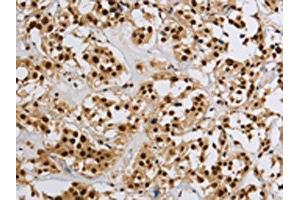 The image on the left is immunohistochemistry of paraffin-embedded Human thyroid cancer tissue using ABIN7190953(HIST1H2AB Antibody) at dilution 1/20, on the right is treated with synthetic peptide. (HIST1H2AB antibody)